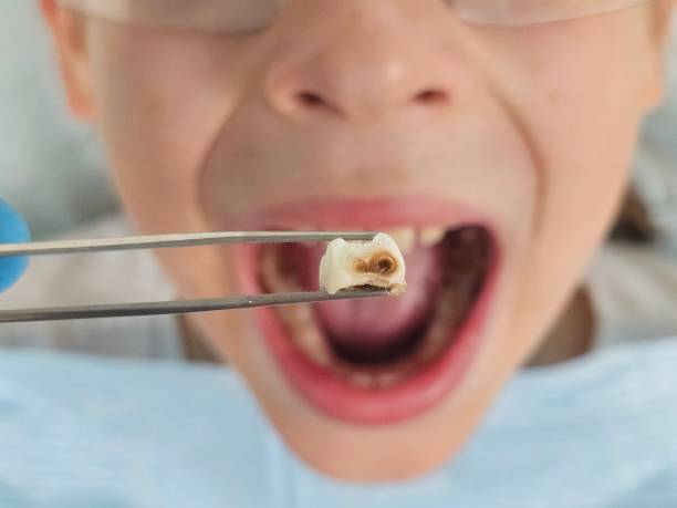 Best Emergency Treatment for Toothache in Lakeport, CA